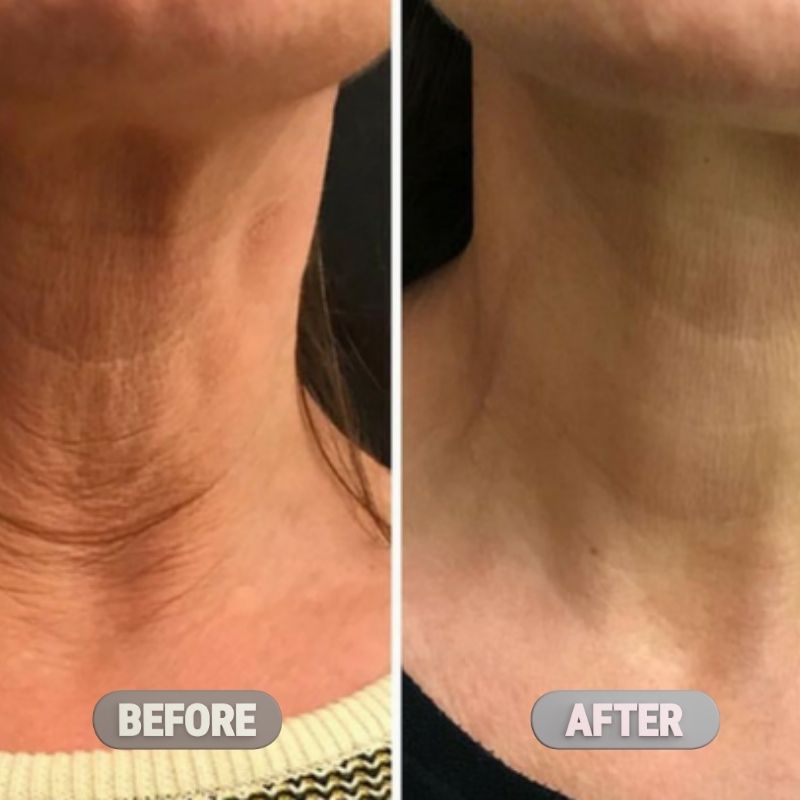 Korean Clinical Neck Rejuvenation Trio™