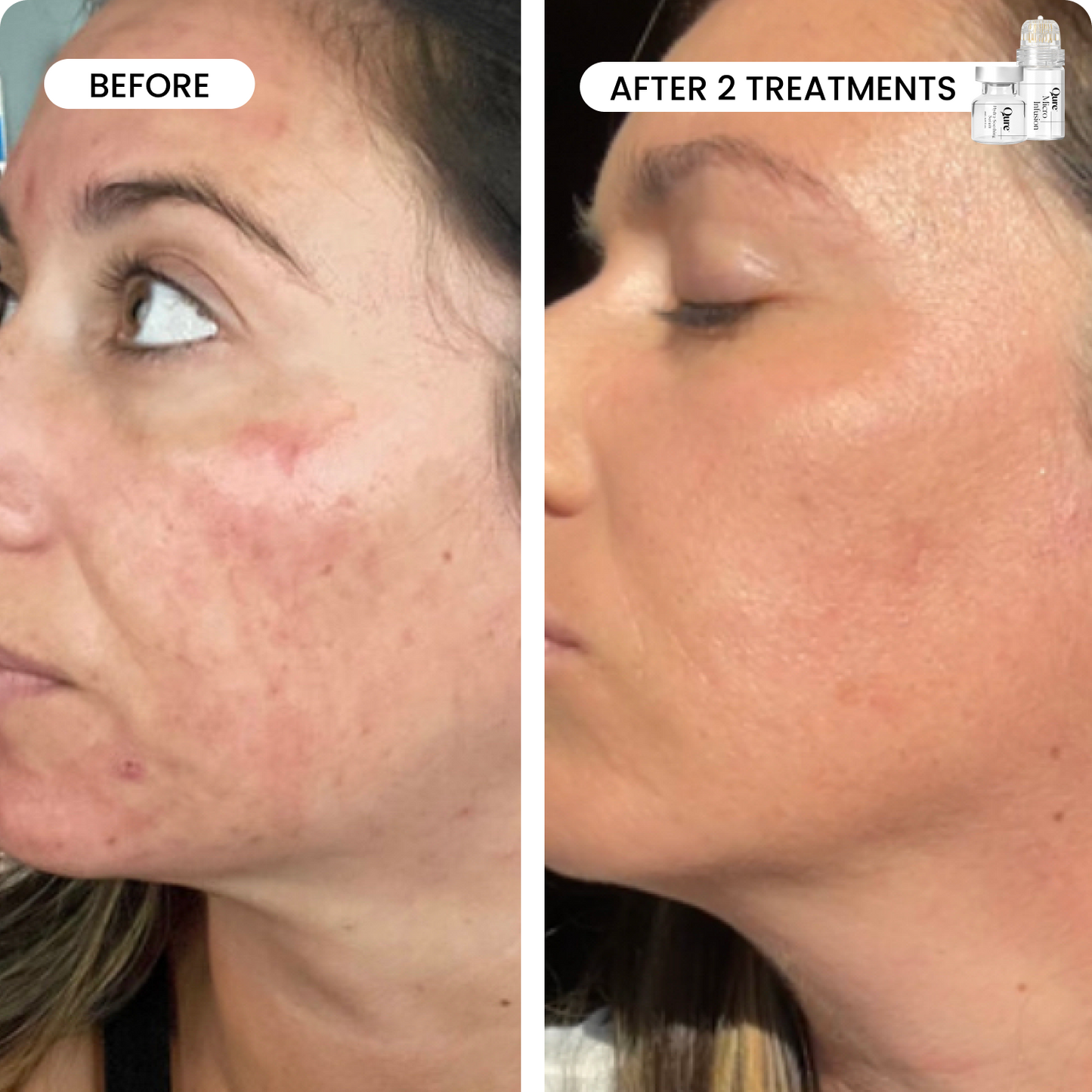 Micro-Infusion 3 Month Bundle (For Wrinkles) (Pre-order)