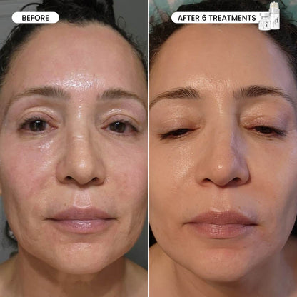 Micro-Infusion 3 Month Bundle (For Wrinkles) (Pre-order)
